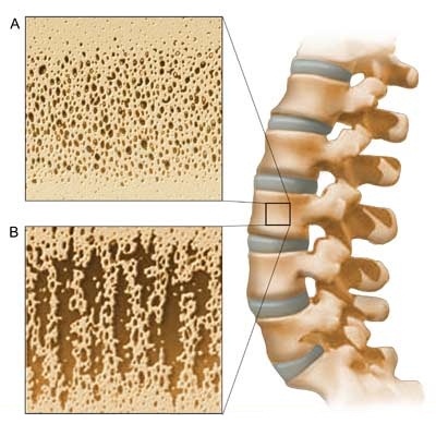 Σύγκριση μεταξύ φυσιολογικού και οστεοπορωτικού σπονδύλου